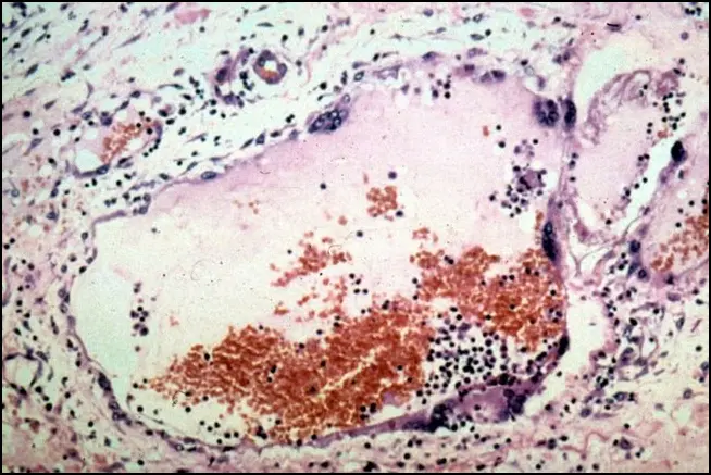 ВОЗ: смертность от вируса Нипах в Индии достигает 75%